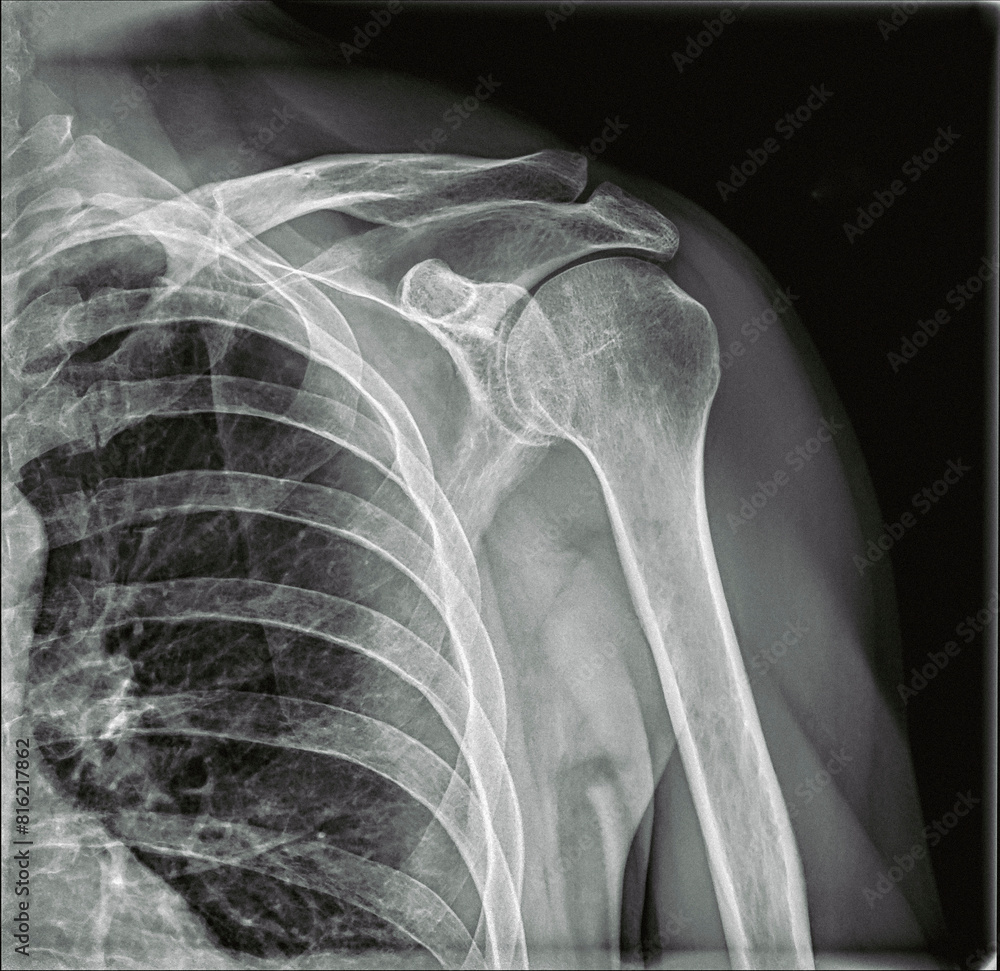X-Ray Radiography of an injured left shoulder X-Ray Radiography of an injured left shoulder