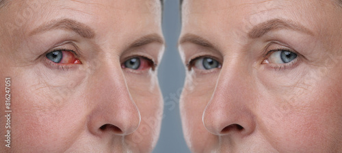 Photos Before and after conjunctivitis treatment