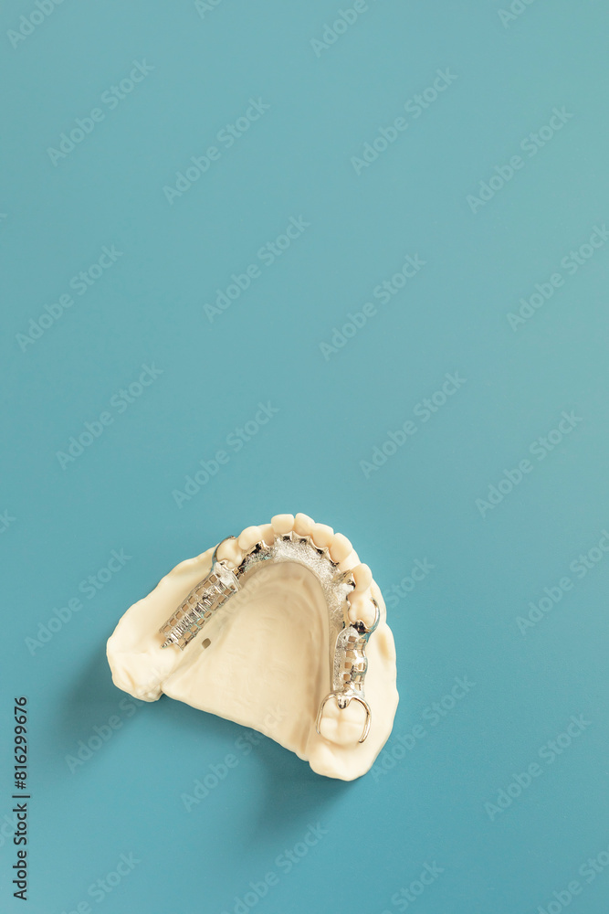 Mockup Metal Frame Lower Partial Denture, Plate On Die Stone, Plaster