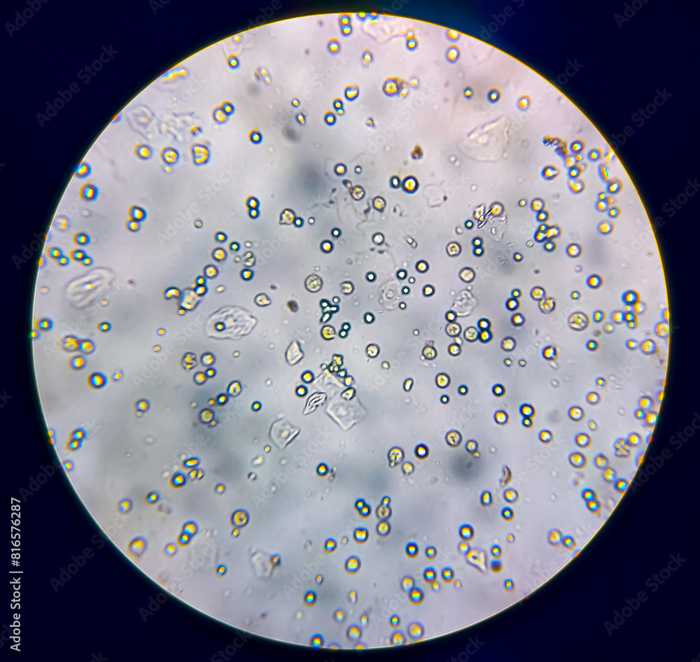 Pyuria or leukocyturia is the condition of urine containing white blood cells or pus. It can be a sign of a bacterial urinary tract infection. Pyuria or leukocyturia is the condition of urine containing white blood cells or pus. It can be a sign of a bacterial urinary tract infection.