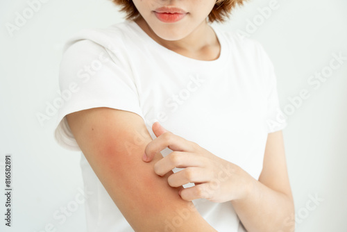 skin problem and beauty. Young woman scratch body has itchy skin from skin allergic, steroid allergy, sensitive skin, red from sunburn, chemical allergy, rash, insect bites, Seborrheic Dermatitis.