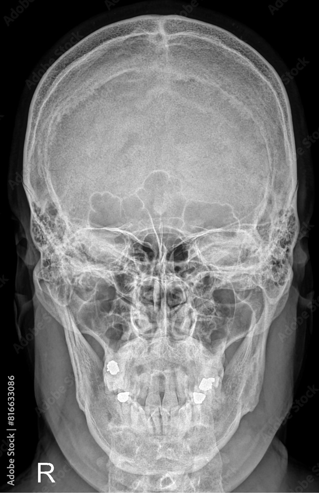 Cerebral Clarity: Detailed Skull X-Ray Cerebral Clarity: Detailed Skull X-Ray