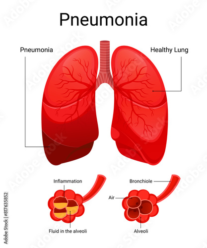 Diagram of pneumonia and healthy lungs