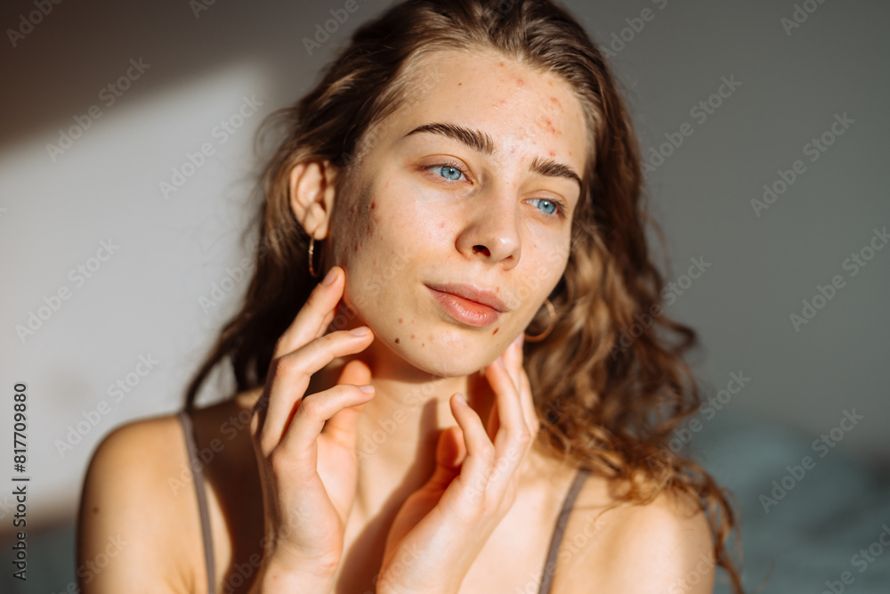 Young woman with acne problem. Dermatology, cosmetology, skin care. Natural skin. Young woman with acne problem. Dermatology, cosmetology, skin care. Natural skin.