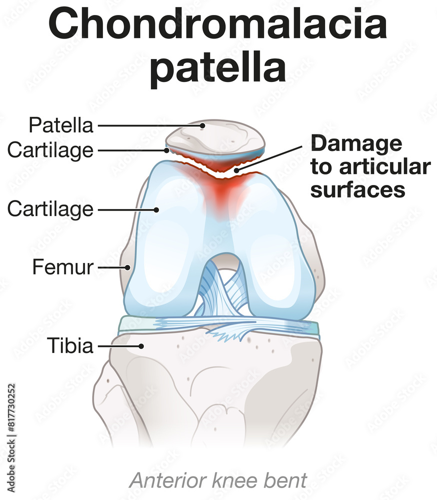 Chondromalacia patella. Knee pain. Runner’s knee. Labeled Illustration