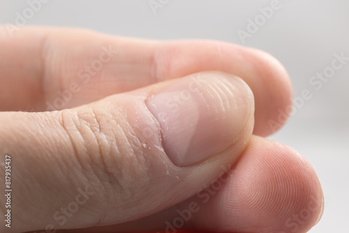 Ridged fingernail of a thumb finger of a man with horizontal ridges on white background.