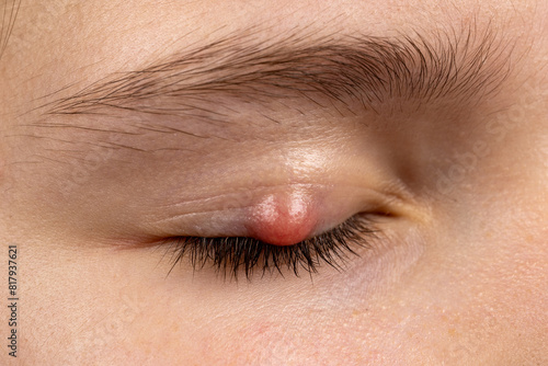 Foto Chalazion on the eyelid of a girl close-up