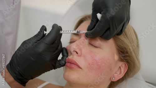 Cosmetology procedure of injection skin rejuvenation. Specialist in black gloves carefully injects filler into skin of face to reduce wrinkles and rejuvenate. photo