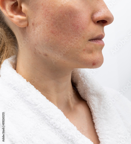 Closeup Face of Woman in her 30s with Acne Problem, Couperosis, Scarring, Blackheads. Vertical Plane, Adult Skin Problem. Cosmetics and Healthcare, Beauty Concept. Rosacea. photo