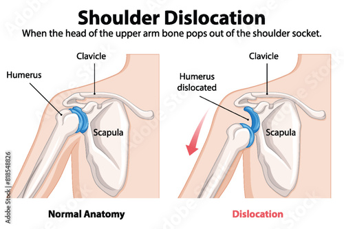 Comparison of normal and dislocated shoulder anatomy