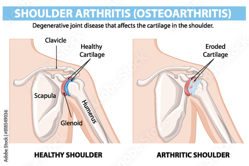 Healthy vs. arthritic shoulder joint diagram