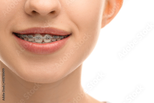 Smiling woman with dental braces on white background, closeup