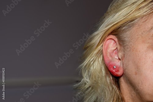 Inflamed earlobe after ear piercing photo