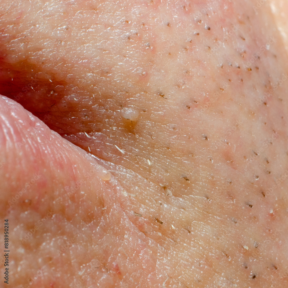 Fototapeta premium fibroma or papilloma on the skin of an adult