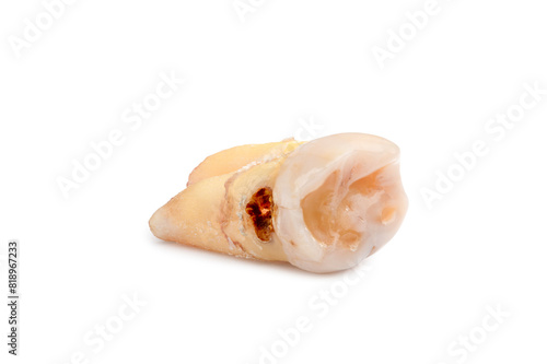 Close-up of tooth with caries isolated on white background. Real teeth, sick human teeth with clipping path.
