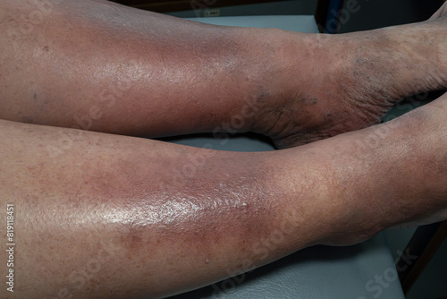 Obraz na płótnie Medical themes: Female senior patient with skin changes caused by venous stasis. Sclerodermiforms w salonie