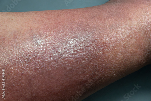 Medical themes: Female senior patient with skin changes caused by venous stasis. Sclerodermiforms