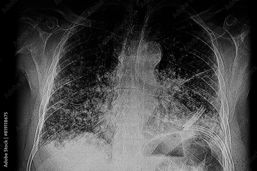 X- Ray image: Multiple small bilateral nodular lesions and spiculated ...