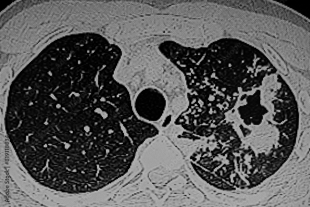 CAT Scan of patient with tuberculosis infection on left lung.