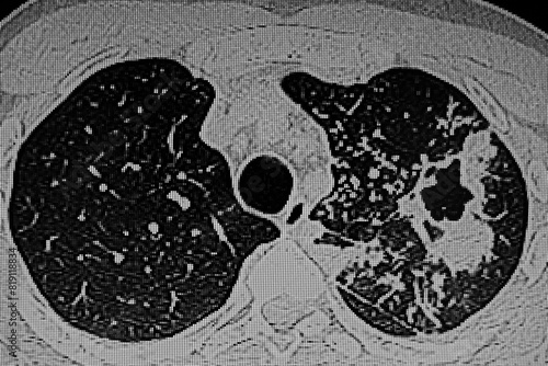 CAT Scan of patient  with tuberculosis infection on left lung.