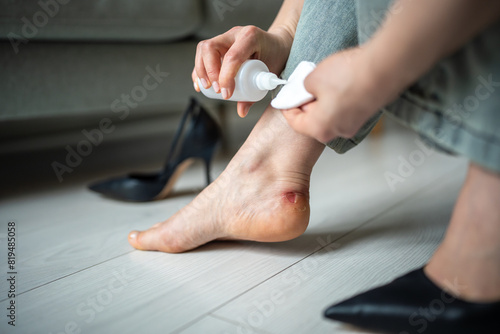 Woman rubbed feet from tight shoes, wiping callus with cotton wool, chlorhexidine. Girl treating bloody wound on ankle with skin antiseptic. Uncomfortable heels hurt legs, corn careful treatment.