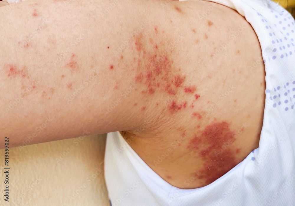 Portrait showing the rash hives allergy and inflammation skin, reaction and urticaria, urticaria and acne on the body, health care and medical concept. Portrait showing the rash hives allergy and inflammation skin, reaction and urticaria, urticaria and acne on the body, health care and medical concept.