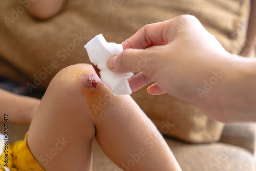 mother applying povidone-iodine solution to her son, which is an antiseptic used in wound care