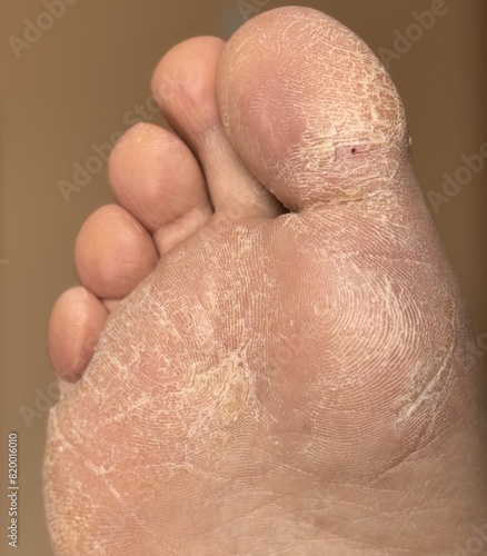 A lot of small cracks and dry flaky skin on the foot. The concept of foot care, pedicure