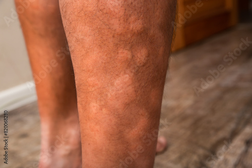 Male feet skin allergic reaction to fever.  Urticaria vasculitis disease causes itchy wheals.  Swollen varicose veins.  Angioedema 