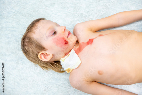 medical procedure dressing a boy with a first-degree burn from boiling water on his face, neck and chest