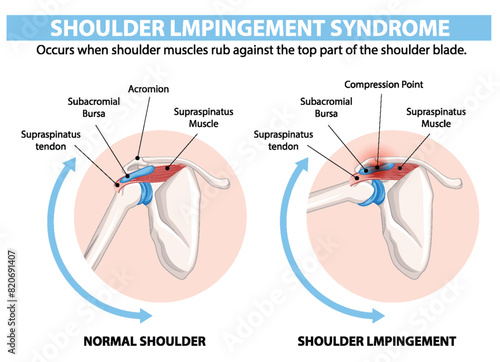 Comparison of normal shoulder and shoulder impingement