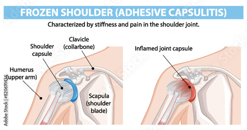 Diagram showing frozen shoulder anatomy and inflammation © GraphicsRF
