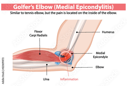 Detailed diagram of medial epicondylitis in the elbow