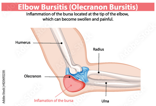 Inflammation of the elbow bursa causing pain