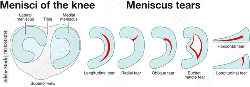 Photography Meniscus tears of the knee joint