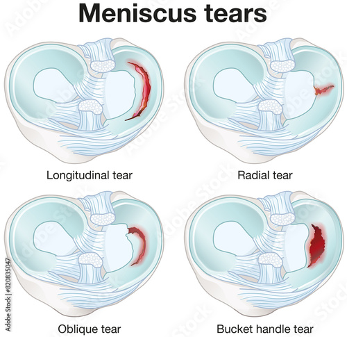 Photography Meniscus tears. Anatomy, injury. Labeled Illustration