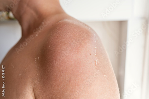 Sunburn on the skin. Exfoliation of the skin after sunburn. Man with sun damaged peeling skin on the shoulders and back. The skin peels off, burnt skin