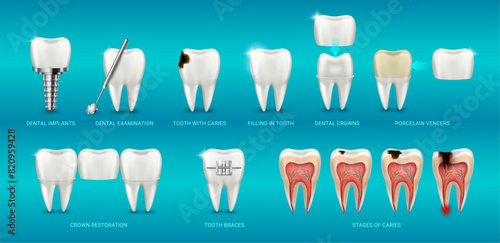 Medicine and healthcare in clinic, teeth care and treatment. Vector dental examination, braces and implants, crown restoration and porcelain veneers, stages of caries and prosthesis filling in tooth