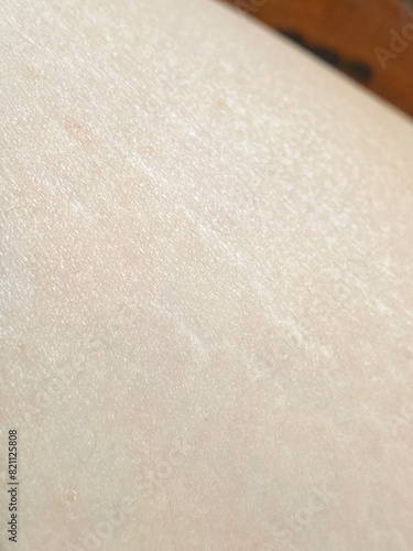 Close up of stretch marks on woman thigh background. Stock photo.