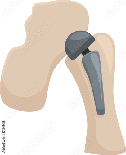 Vector graphic of a hip joint replacement, showcasing a medical prosthetic implant