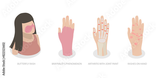 3D Isometric Flat  Illustration of Systemic Lupus Erythematosus, Butterfly Rash Red Patches photo