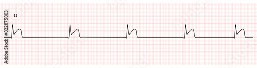 EKG Monitor in lead II Showing  junctional Bradycardia with STEMI at Inferior Wall
