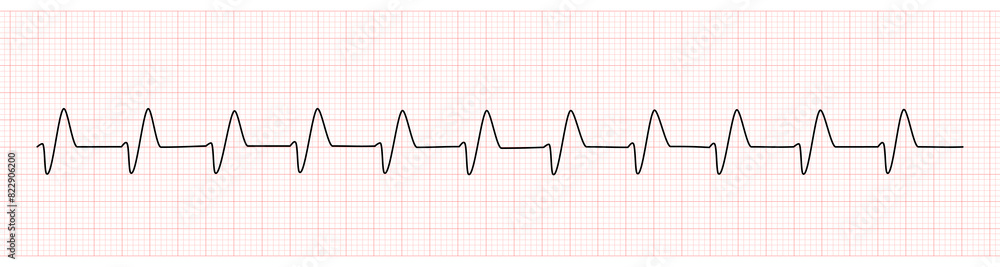 EKG Monitor Showing Wide QRS Complex From Hyperkalemia
