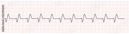 EKG Monitor Showing Wide QRS Complex From Hyperkalemia