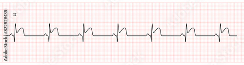 EKG Monitor in lead II Showing  Sinus Rhythm with Late STEMI at Inferior Wall with Deep Q Wave