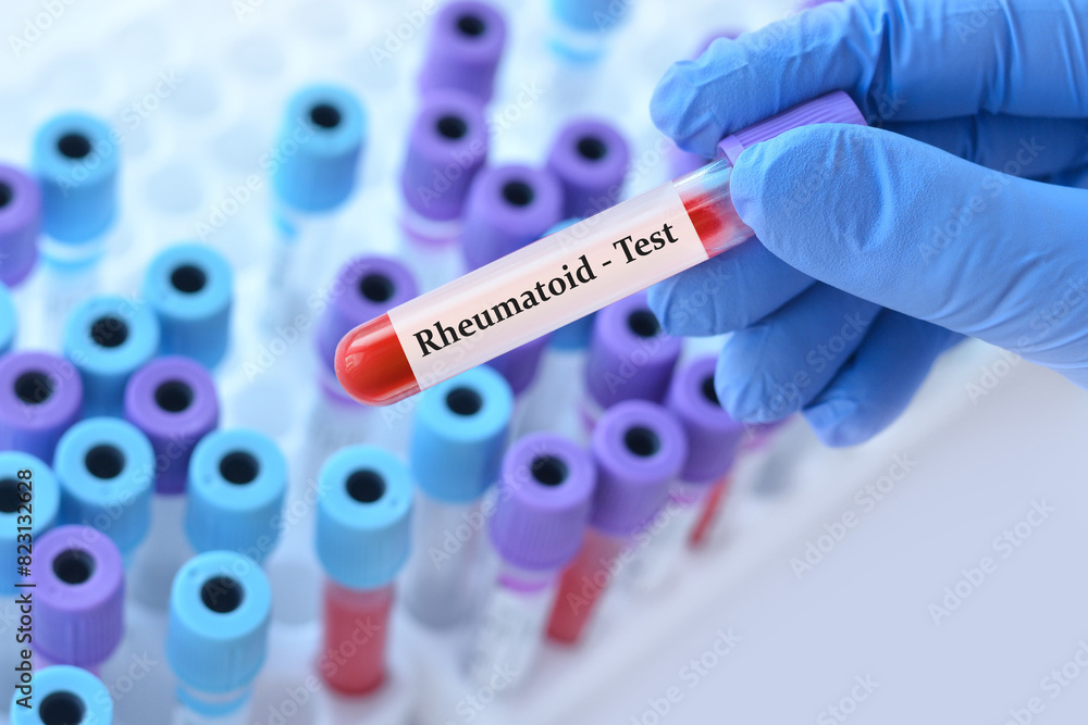 Obraz premium Doctor holding a test blood sample tube with rheumatoid factor (RF) test on the background of medical test tubes with analyzes. Banner