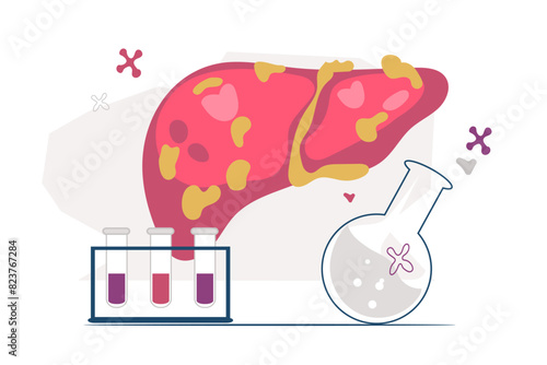 Non-alcoholic fatty liver NAFLD or steatohepatitis, flat vector illustration isolated on white background. Human liver with fatty deposits, precancerous condition.