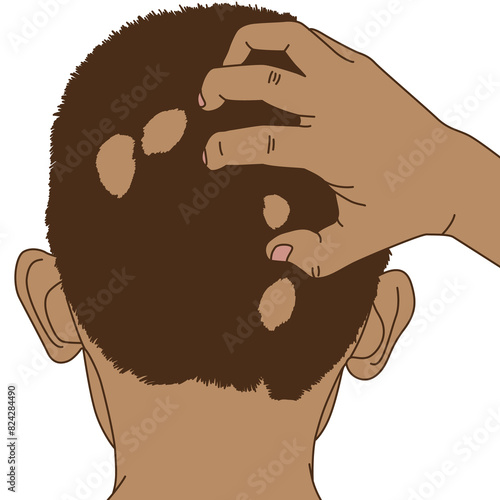 Back view of tan man alopecia areata bald spot, illustration on white background