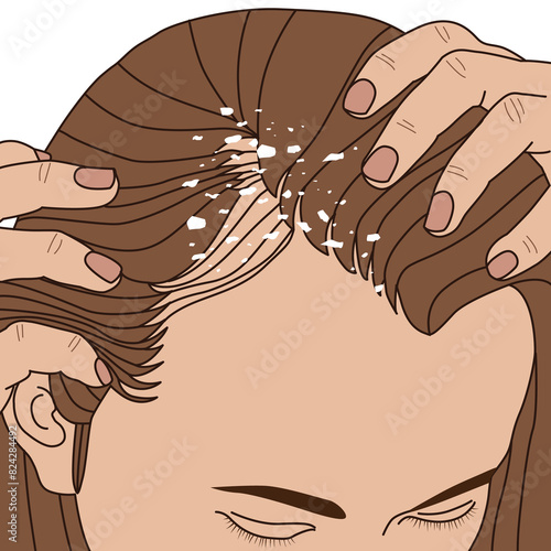 Dandruff on woman's scalp alopecia areata bald spot, illustration on white background