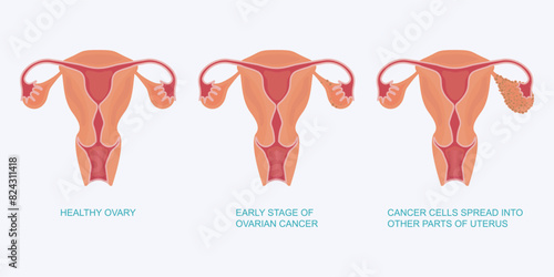 Stage of ovarian cancer. photo